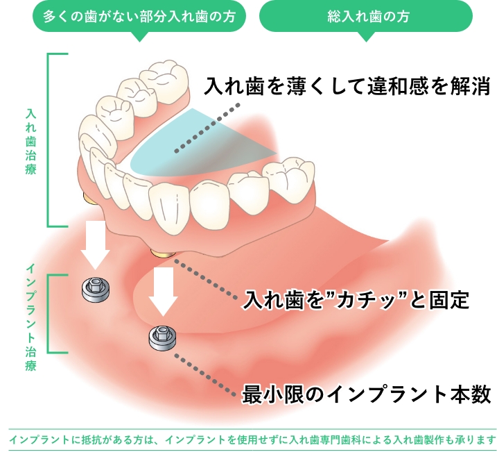 入れ歯＋インプラント治療の装着の様子