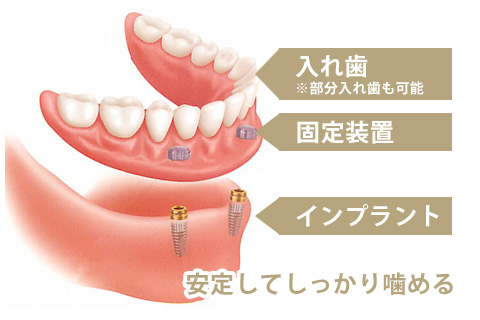 入れ歯とインプラント治療を併せて安定の噛み心地