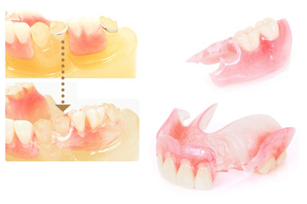 目立たない入れ歯