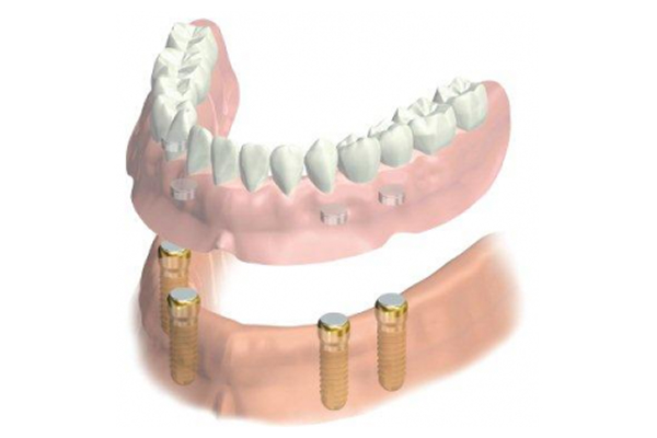 入れ歯とインプラントの併用