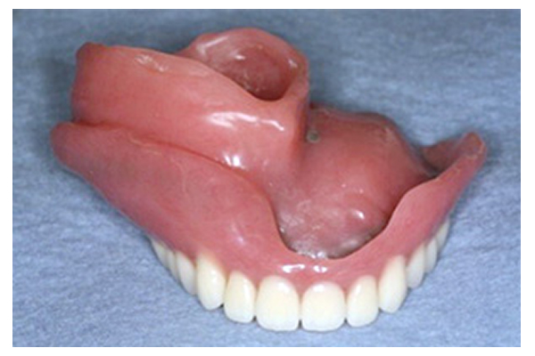 特殊入れ歯（顎顔面補綴）