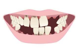 状態の悪い歯イメージ
